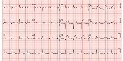 acute myocardial infarction ecg